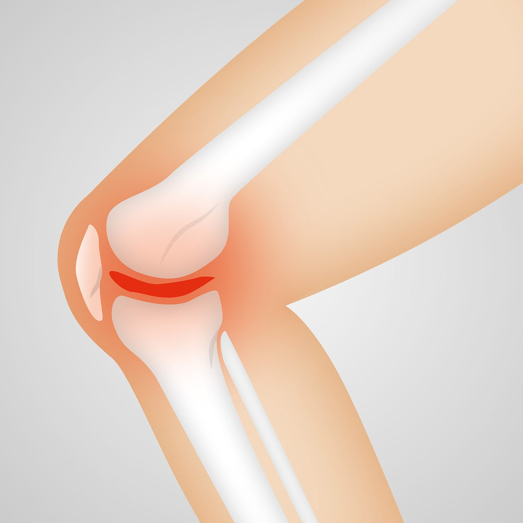 How Under-Active Glutes Relate to Knee Pain